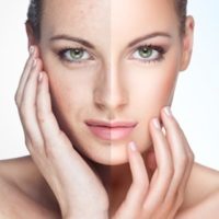 before-after-laser-skin-rejuvenation-1